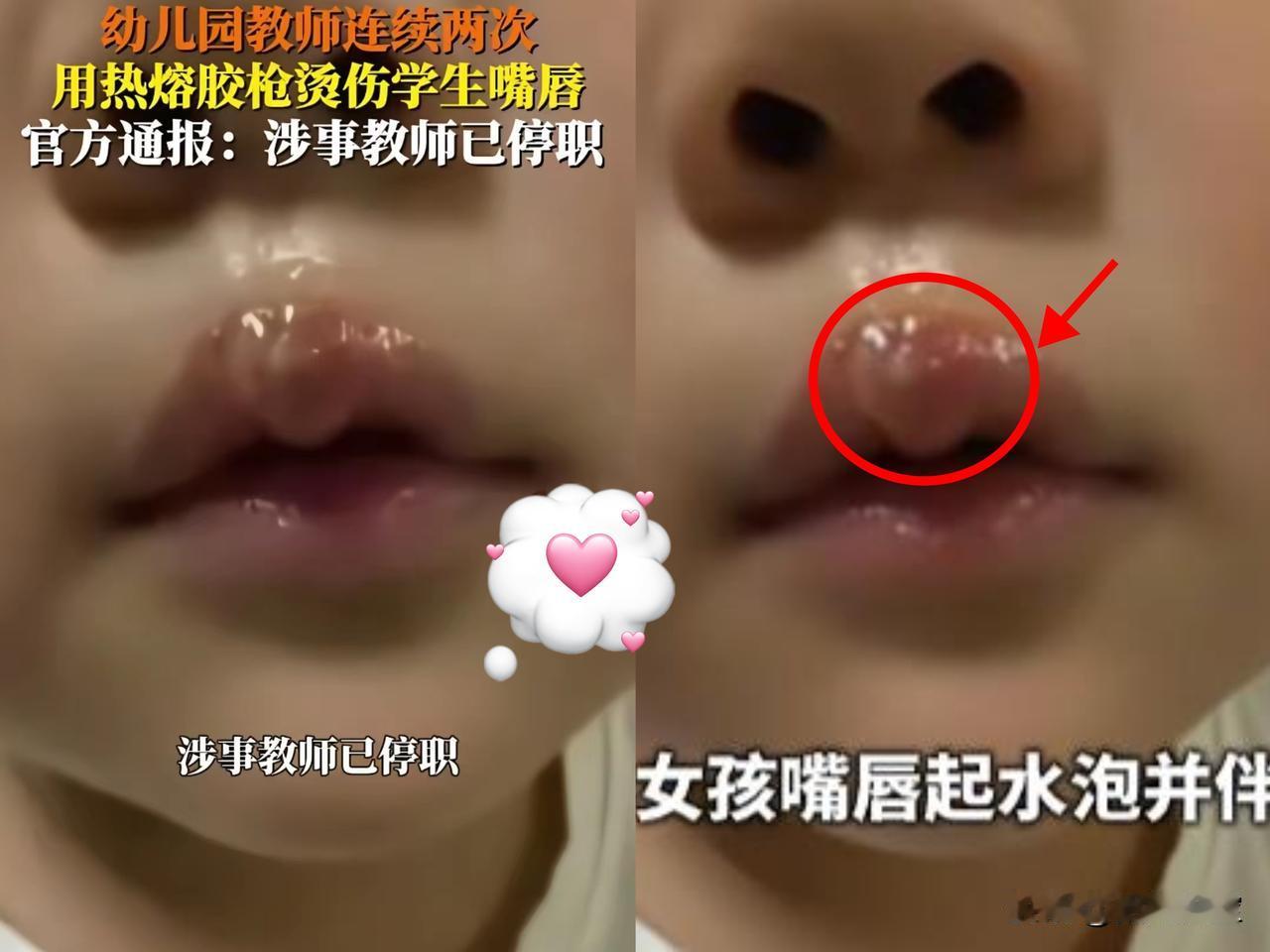 已经有家长出来发声了，
​原来在热熔胶烫嘴之前，
​就已经有一批孩子被烫过了，而