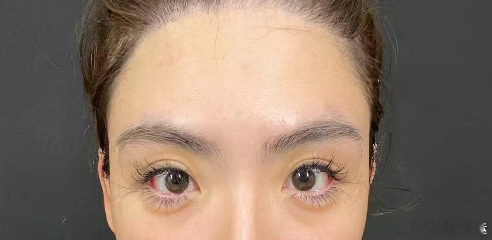 我当时做外眼角➕上移的时候，医院给我拍的当时眼睛好大一个，现在倒回去看，确实回缩
