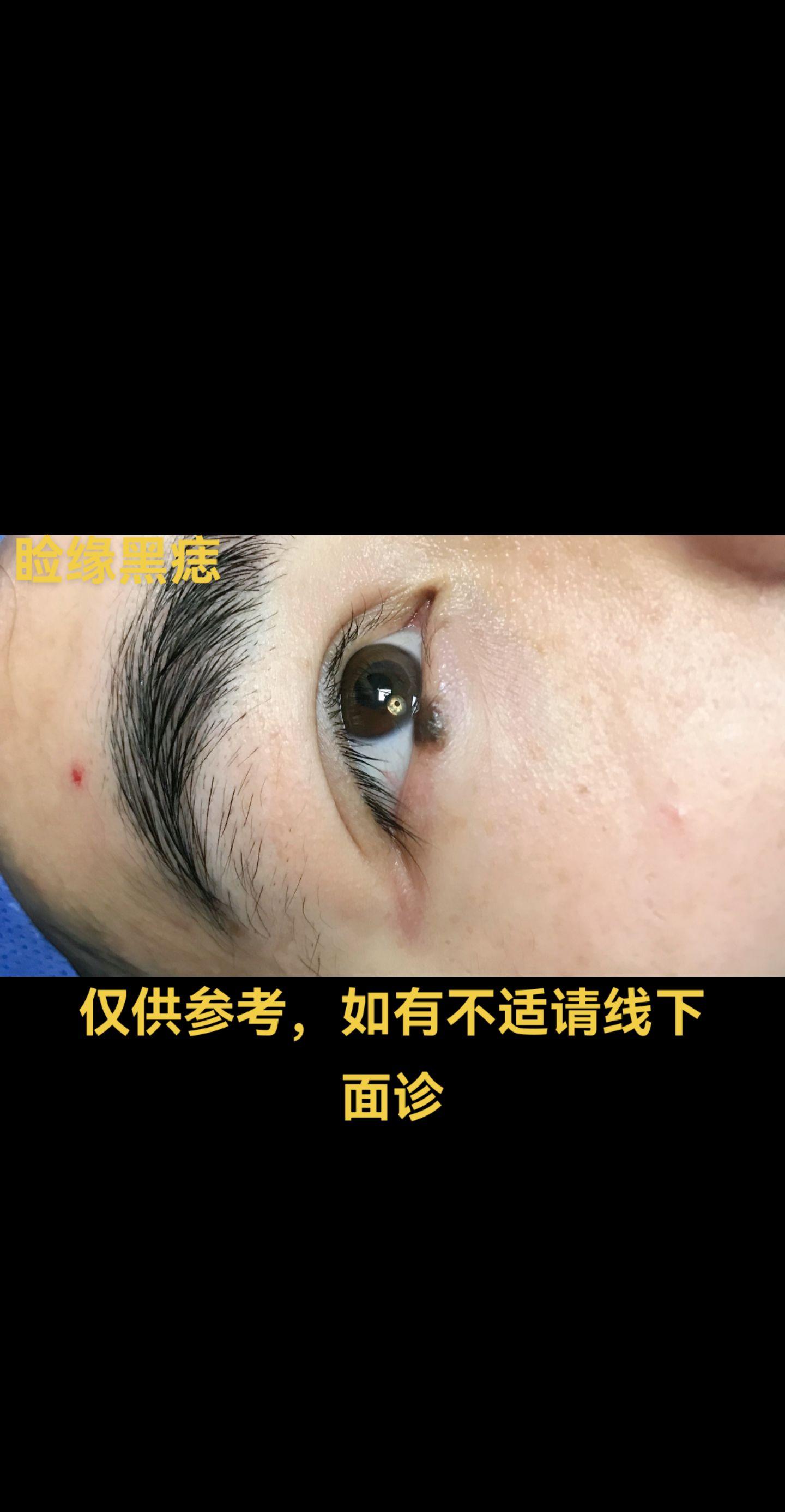 黑色素痣。一般分为交界痣、皮内痣和混合痣。
面部黑痣