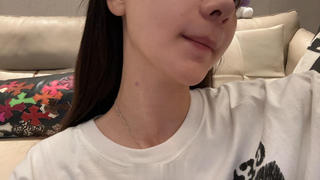 今天打了颈阔肌提升 打过的朋友都说好 哈哈哈哈 我也试试 ​​​