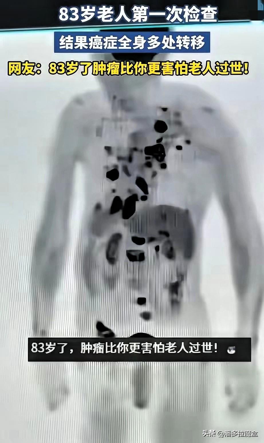 安徽这事儿真是让人看不懂了，83岁的大爷生平头回体检，结果出来吓死人，癌细胞全身