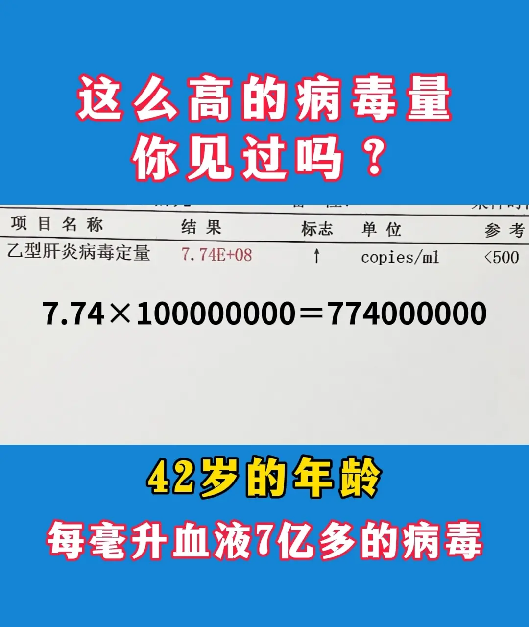 大家好，我是张峰主任！看乙肝大三阳、小三阳、肝硬化已经30年了，遇见过...