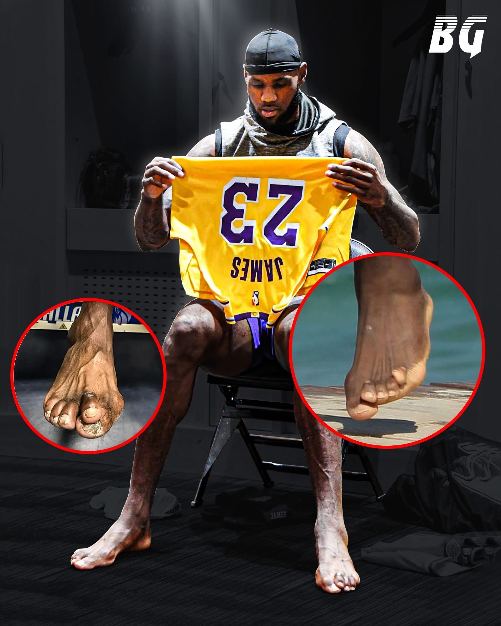 征战23年后，勒布朗·詹姆斯的脚现在变成了这样🔶他的双脚都有明显的严重拇外翻（