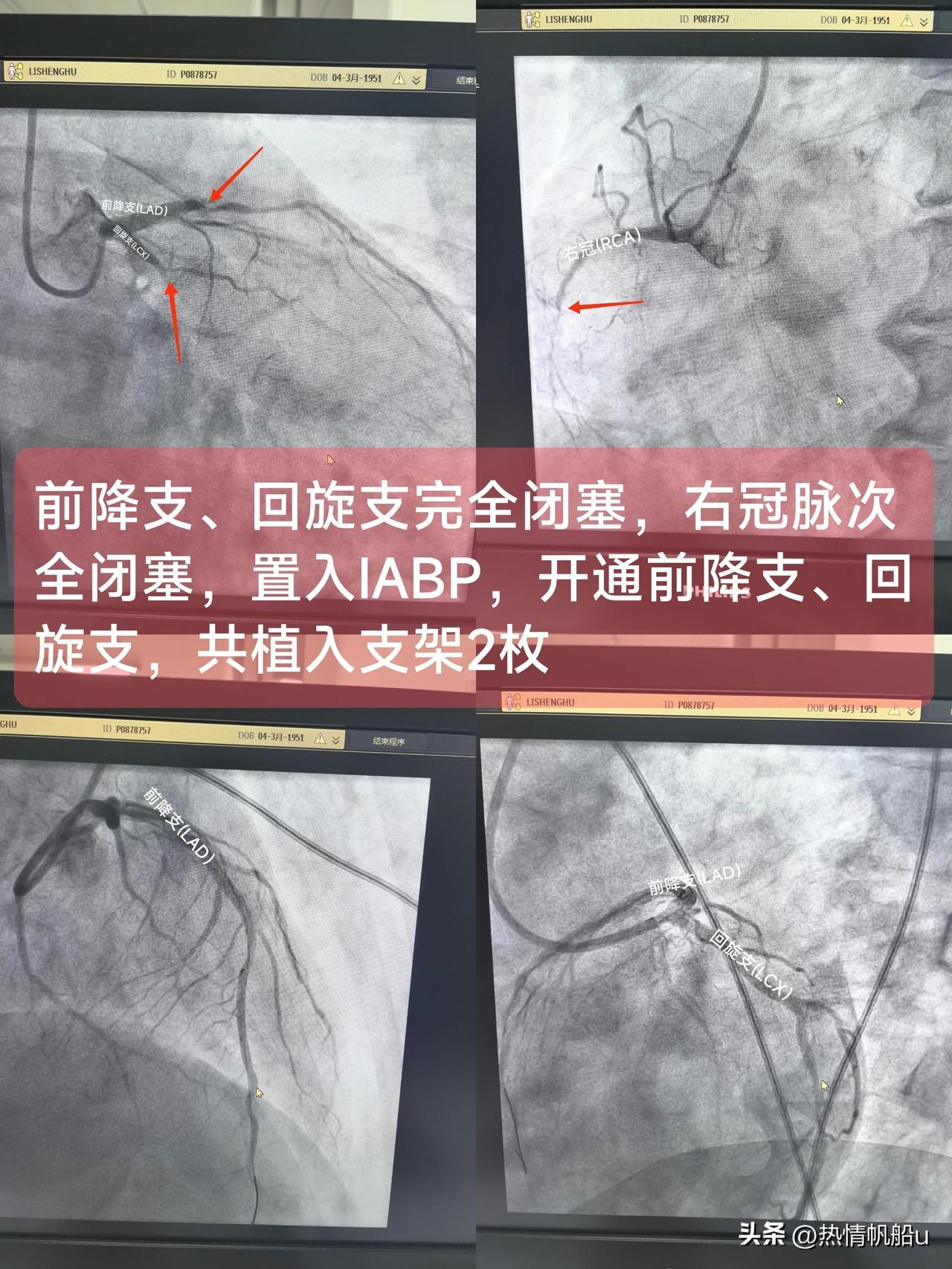 急性ST段抬高型心肌梗死
(冠脉三支病变)

冠脉三支病变是指冠状动脉的3条主要