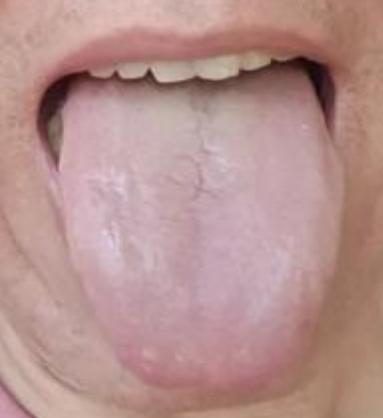 最难补的阳是肾阳！这种阳虚舌象，不仅要补肾阳，还需要“引火归元”！主诉：身体乏力
