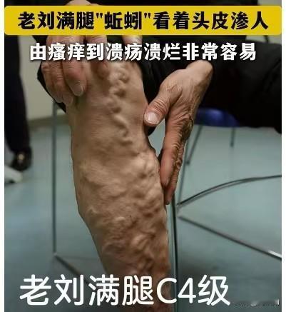 凸起、扭曲的血管像无数条蠕动的蚯蚓，密密麻麻爬满整条小腿，在皮肤下盘根错节，视觉