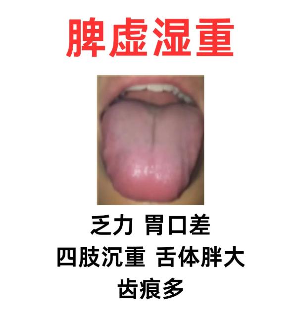 乏力、腹胀、大便稀？对照这几种脾虚看看