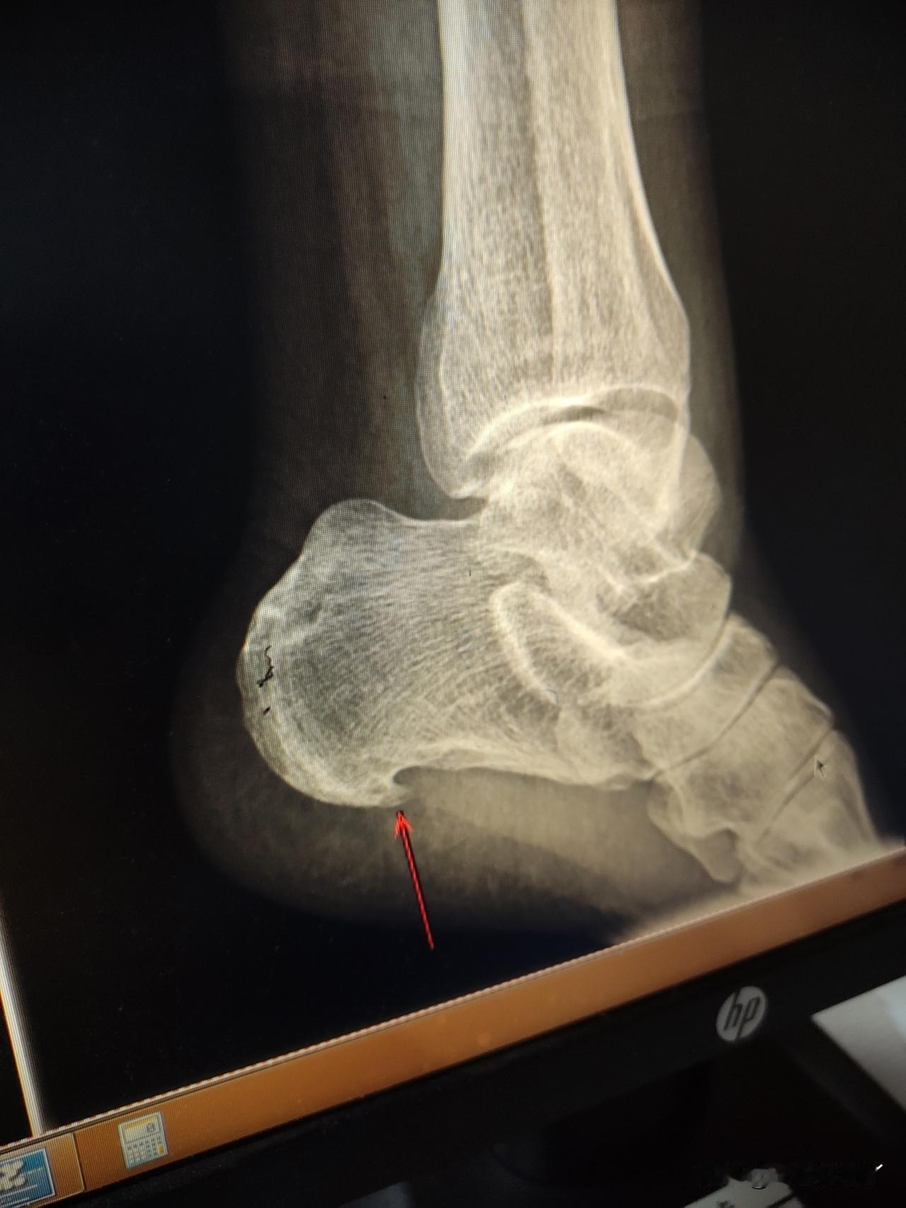 麻团儿今天去取牙模。
等待的空挡儿，我挂了个骨科看看我的脚后跟为啥疼。
脚后跟有