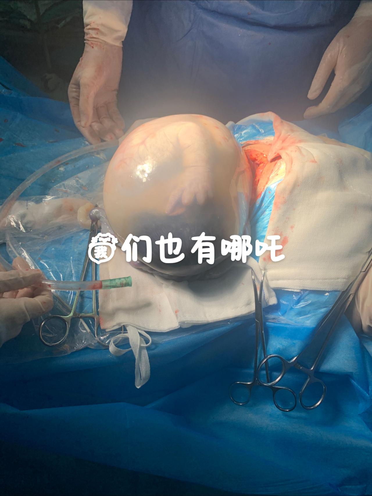 在剖宫产手术中，若胎膜保持完整并连同胎儿一起取出（称为“胎膜内剖宫产”或“en 