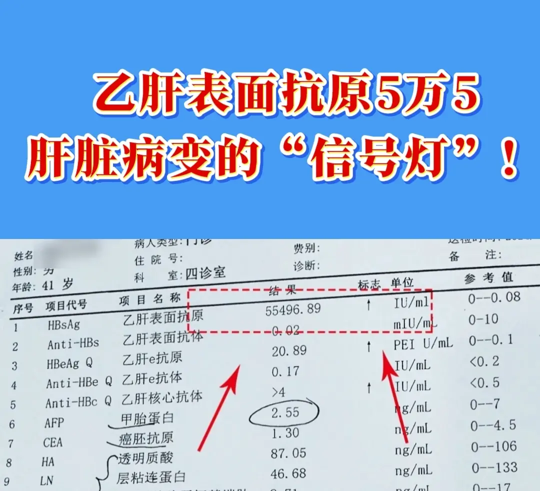 前几天面诊的一个患者，表面抗原5万5千多，属于特别高的了。加上他的乙肝...