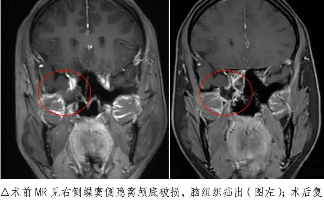 春夏广东，39岁女人流清鼻涕20天，以为鼻炎小事，谁知竟是脑脊液从脑壳缺口狂泄，