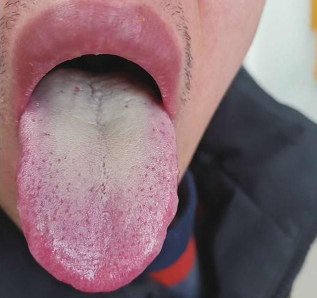 看看，这就是典型的男科不及格舌象！别再忽视了！

前段时候有位粉丝来我这看诊，主