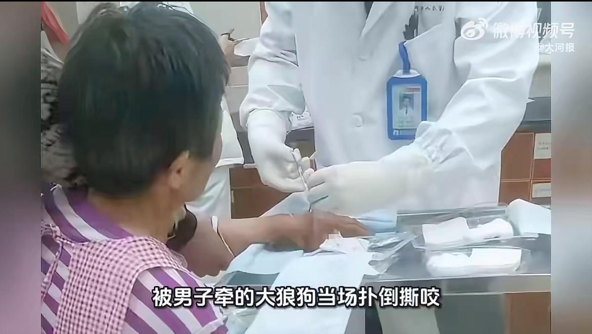 太可怕了！浙江诸暨的俞大姐上班路上被大狼狗扑咬得满手是血，摔得胸口一大片乌青，狗
