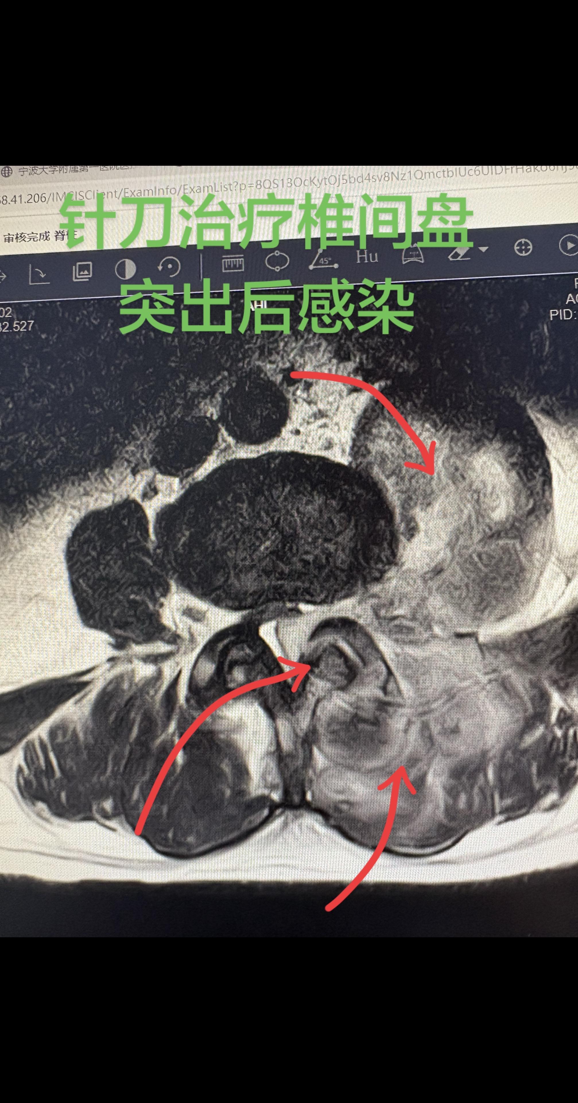 腰椎间盘突出请谨慎选择有创治疗。可怕的针刀治疗后感染，脓毒性休克，侥幸...
