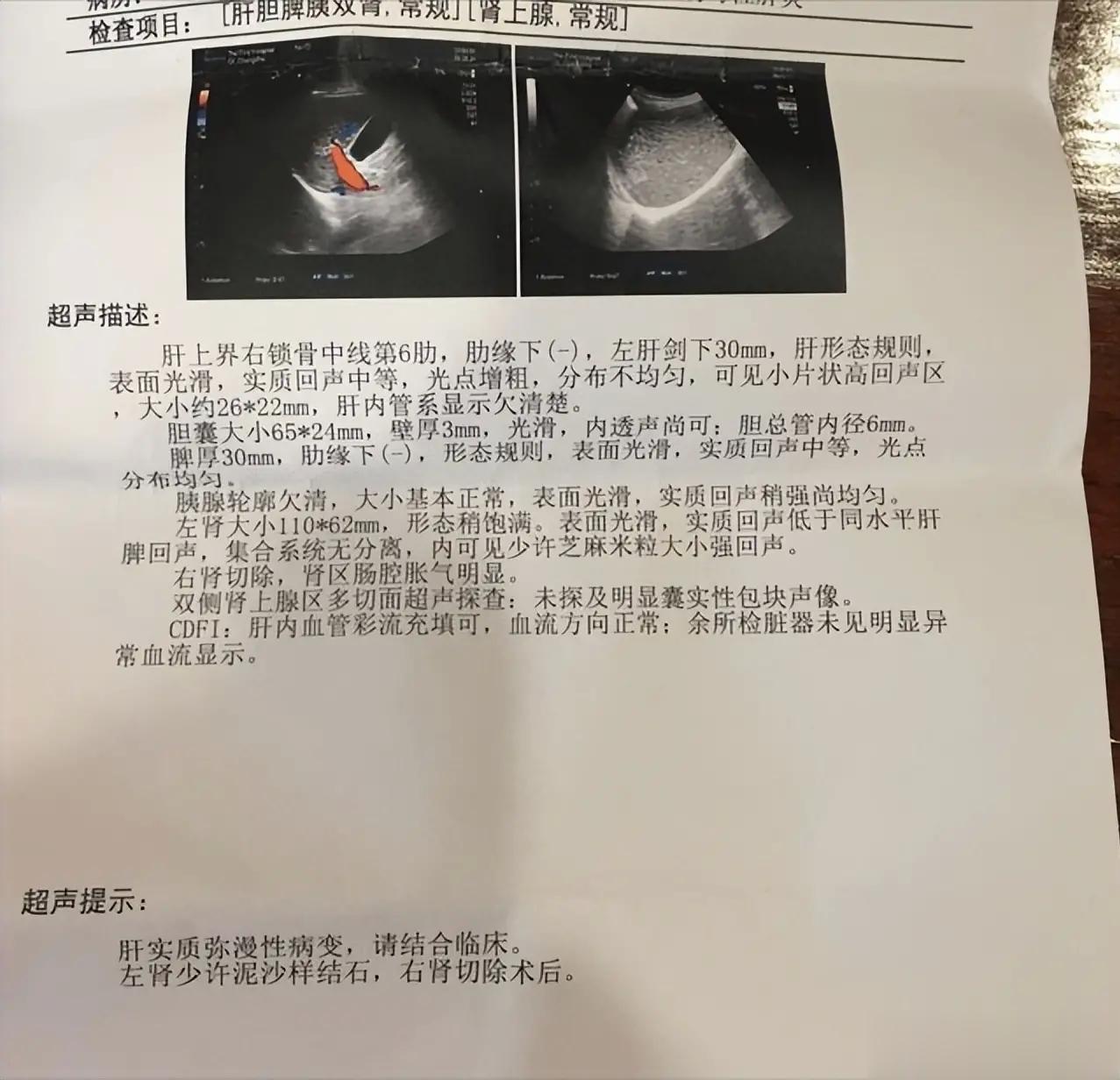 “肝弥漫性病变”“肝实质性占位”不一定就是肝硬化、肝癌，还可能是这几种肝病。 很