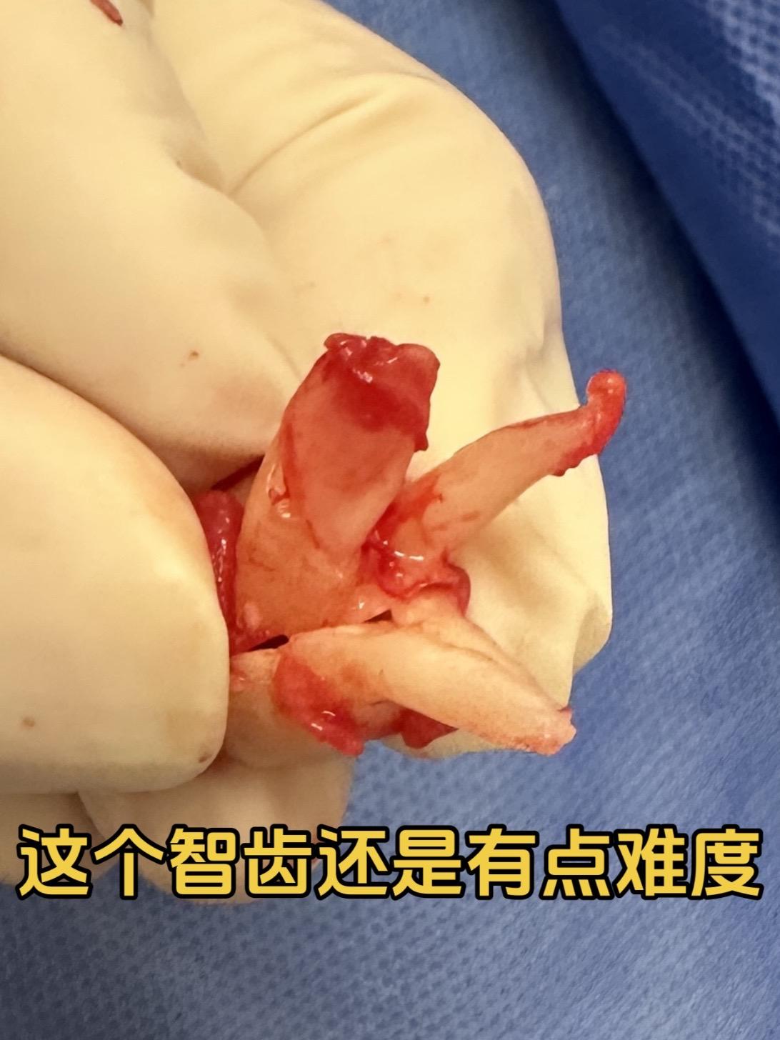 这个智齿还是有点难度。智齿的牙根分叉很大，有点难度。