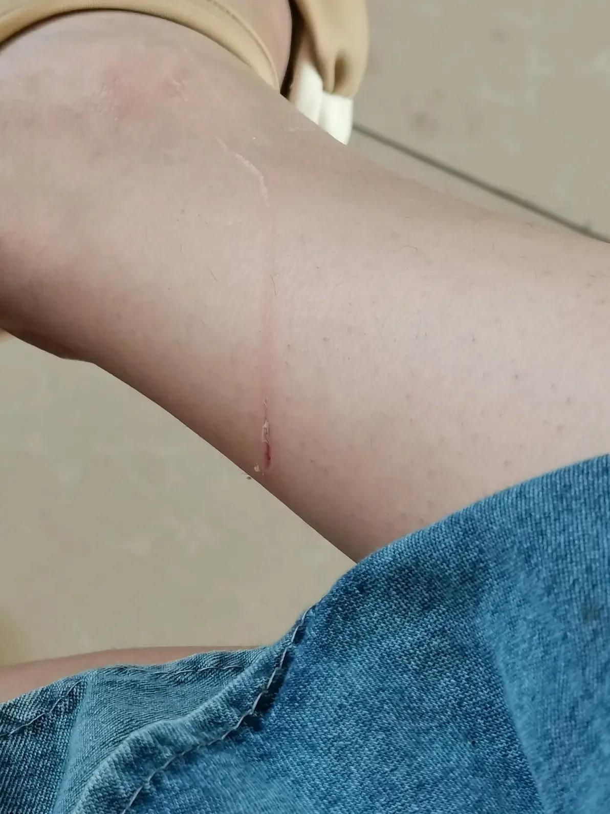 云南，女子路过邻居家，被邻居家的小狗咬伤了她的膝盖和脚，邻居也负责，马上带她去打