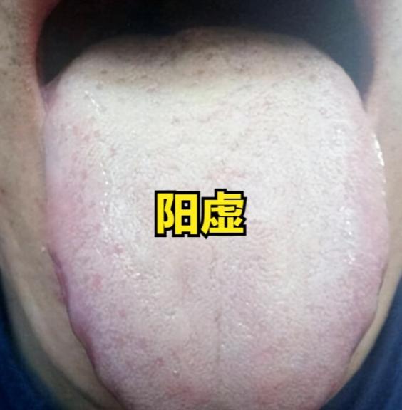 便稀黏腻粘马桶？别只祛湿！是脾胃阳虚缺 “火力”
大家好，我是中医陈大夫！
好多