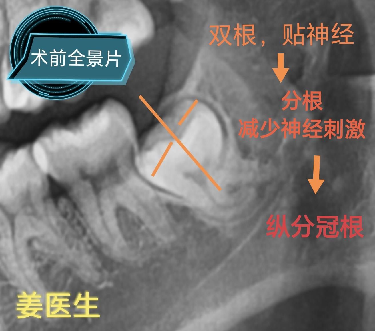 贴神经管双根智齿拔除