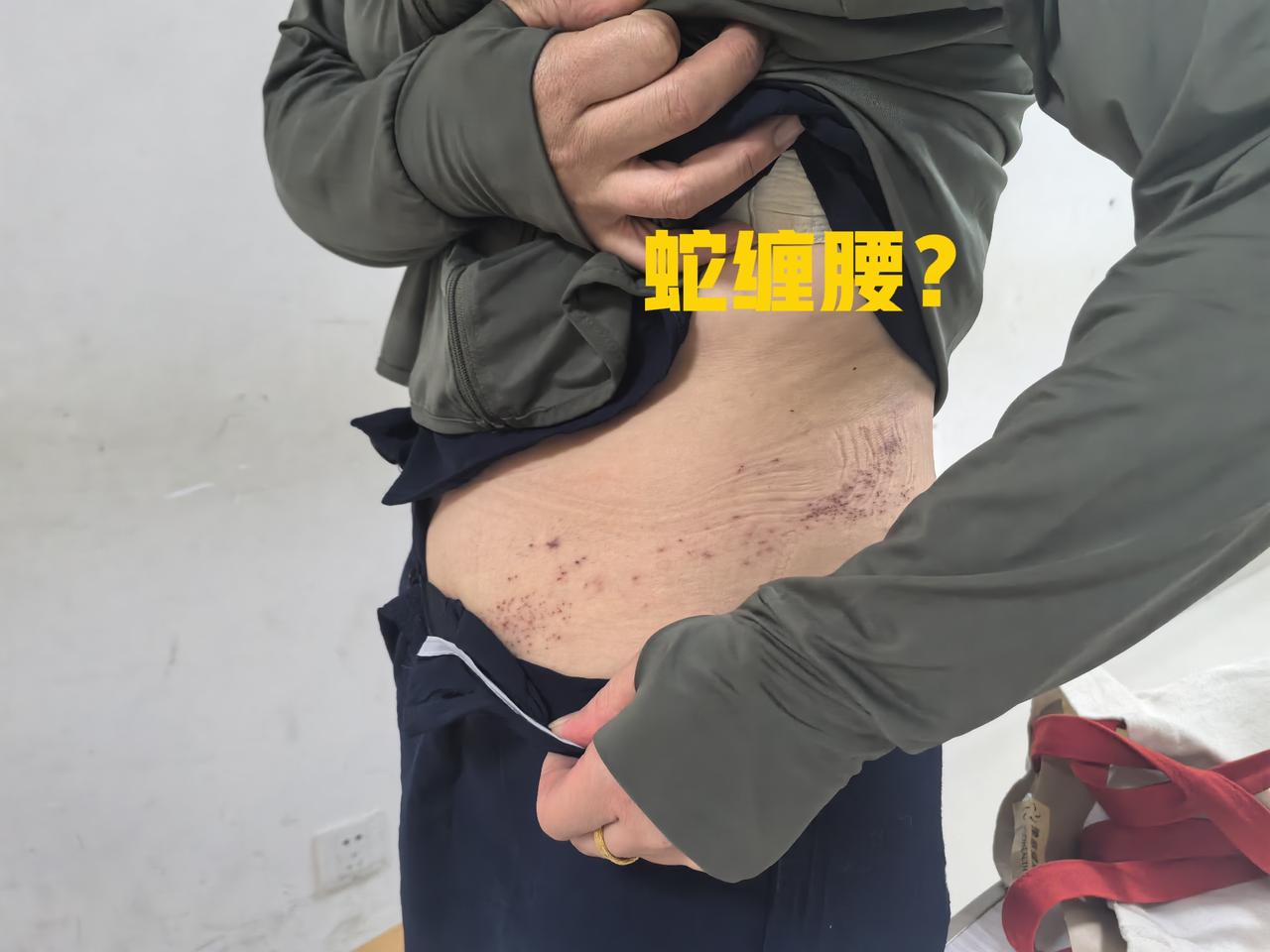 今天门诊来位年轻姑娘，二十多岁，说腰上长了东西，又疼又痒。她把衣服撩起来，左侧腰