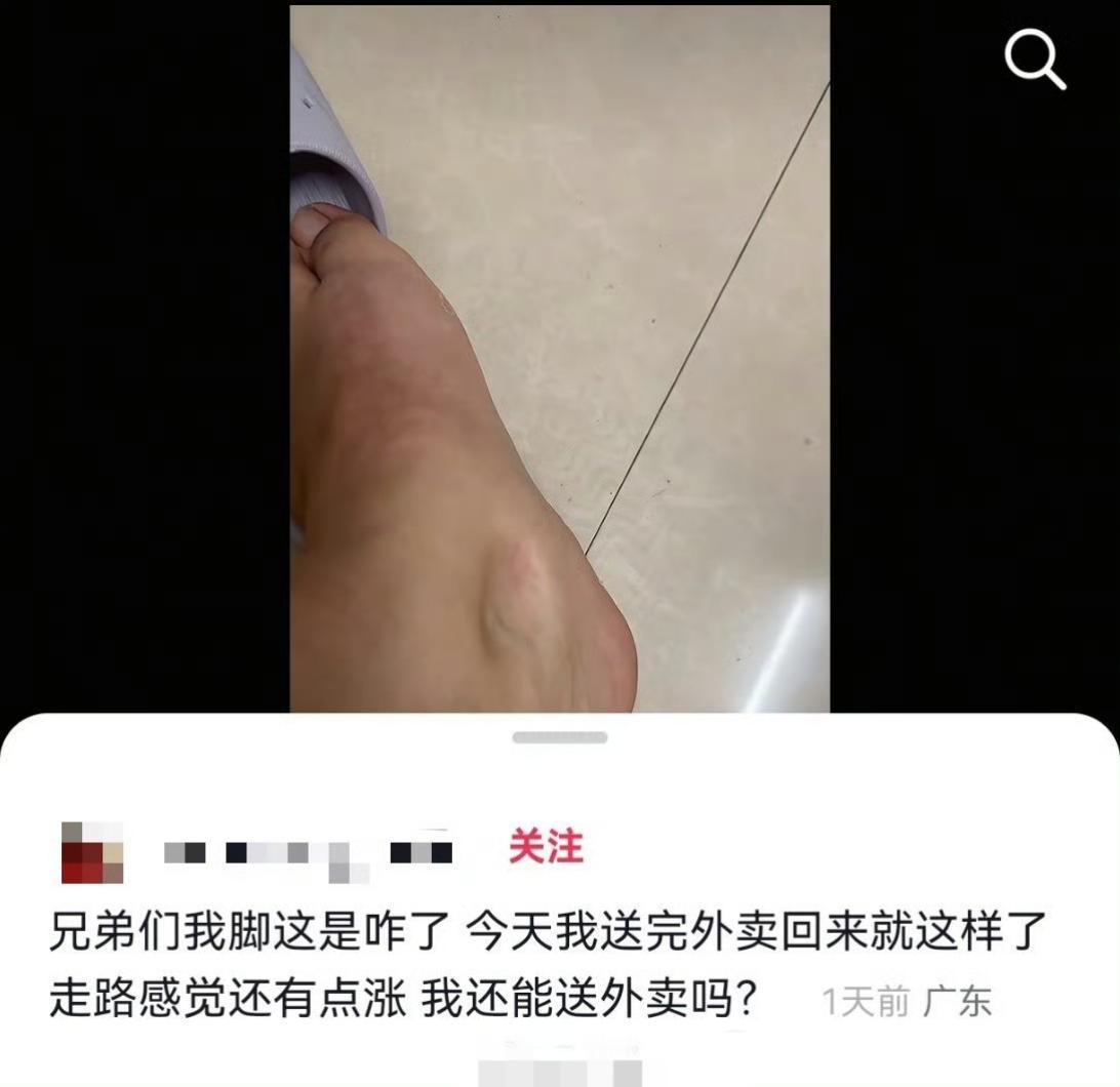 不要憋尿！外卖小哥发现脚肿手指一按一个坑，听网友去医院检查肌酐高达864，已经是