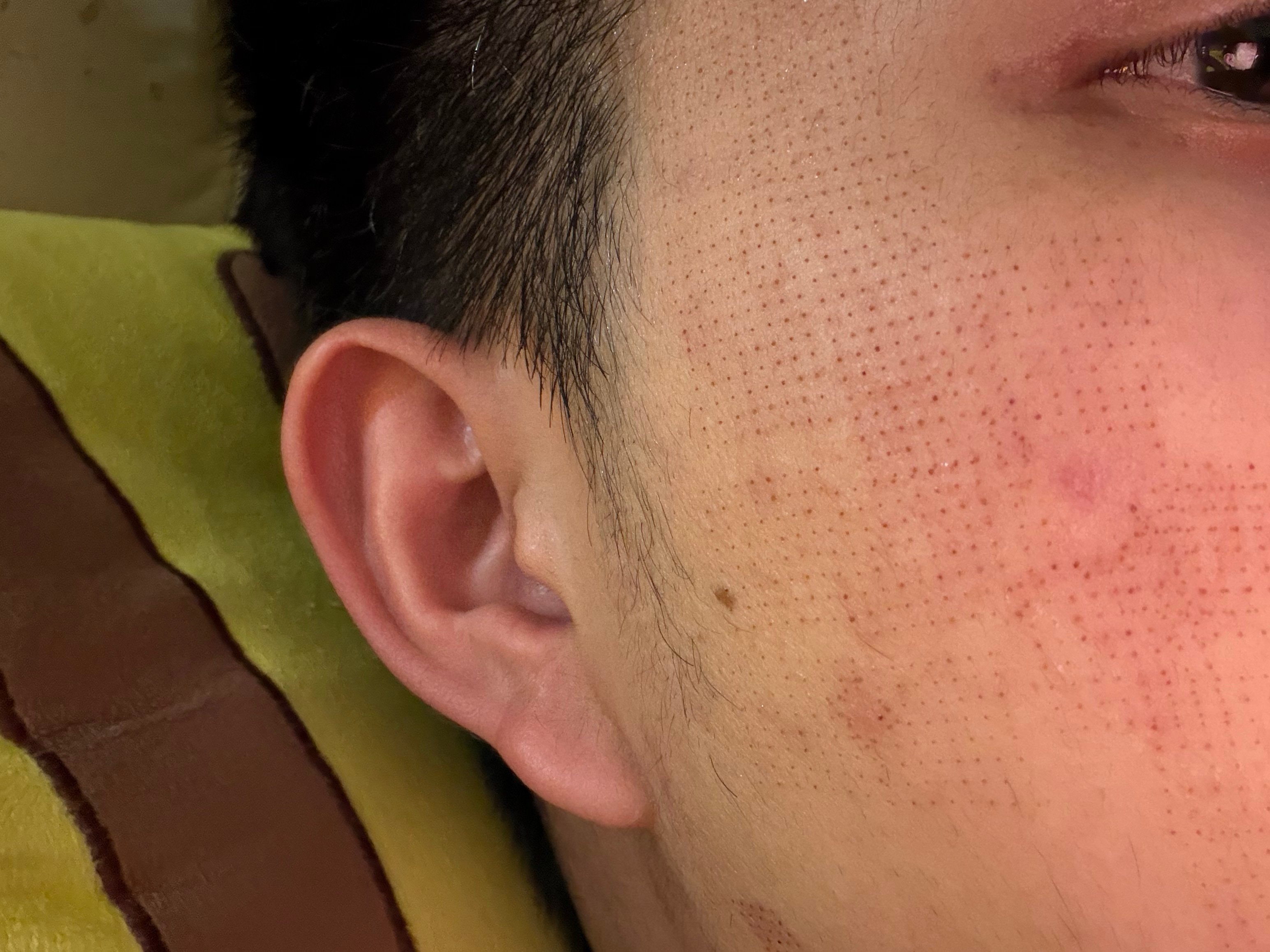 第一次做点阵，上周末做的，昨天同事说我脸小了？我心里想可能是做完后的那两天饿瘦了