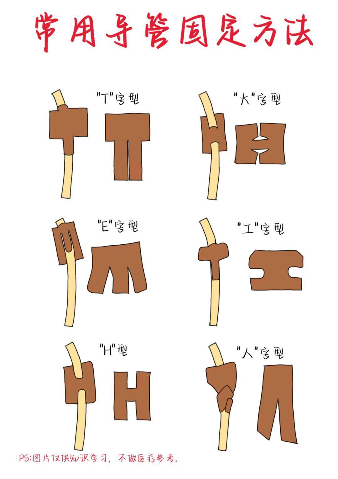 医学生笔记——常用导管固定方法