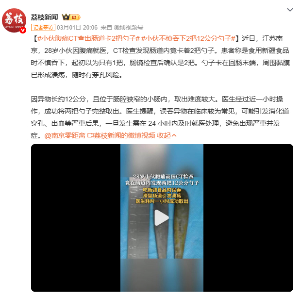 小伙腹痛CT查出肠道卡2把勺子网友热议：这勺子得是“成精”了吧？南京小伙腹痛就医