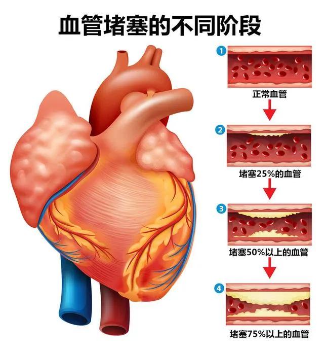 化瘀新解：活血非唯一，三招助你根除血瘀

在探讨化瘀的话题时，我们常常会听到“活