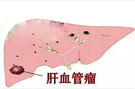 4种常见的肝结节类型，如何针对性治疗？1. 肝血管瘤一般都是良性的，表现为高回声