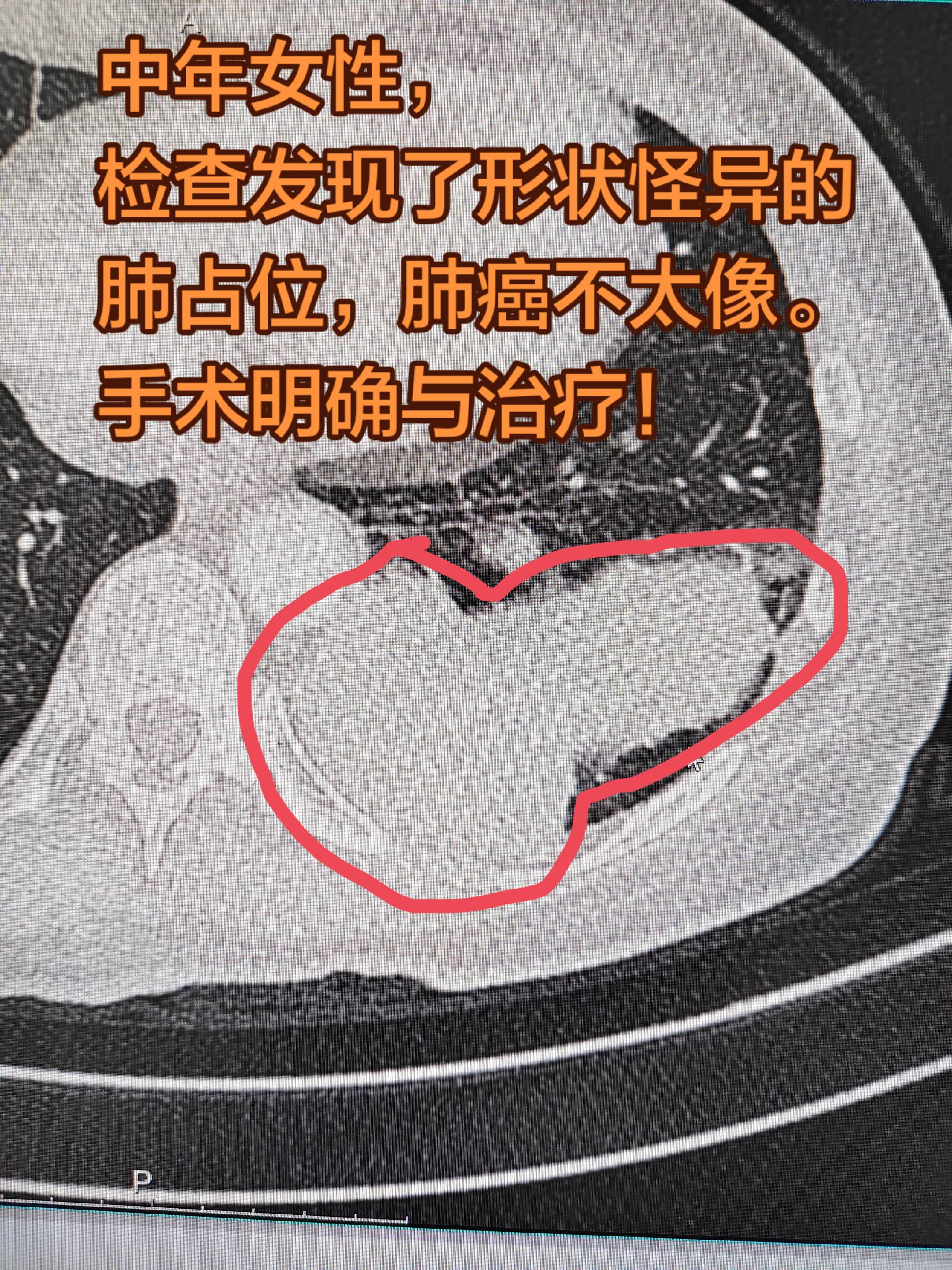 特殊的肿瘤。中年女性， 检查发现了形状怪异的肺占位，。 评估全身情况...