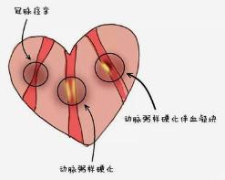 27岁小伙突发心梗，连夜抢救！原因扎心了，很多人都中招

在现代社会，心脏病早已