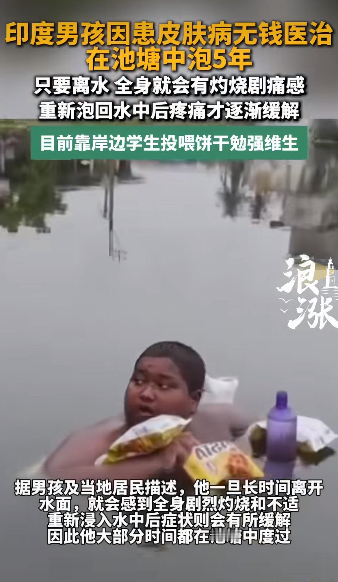 印度16岁男孩，伊克巴尔得了种怪病，离水久了浑身像被火烤的疼，家里穷得掏不出治病