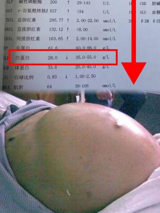 白蛋白低到多少会出现腹水？