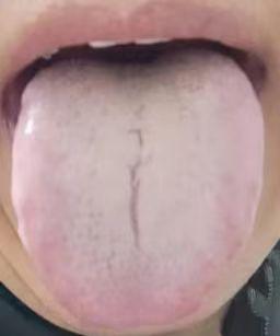 【舌诊分析】很久没见到这么典型的舌象了，舌头几乎看不到血色，显得十分苍白

患者