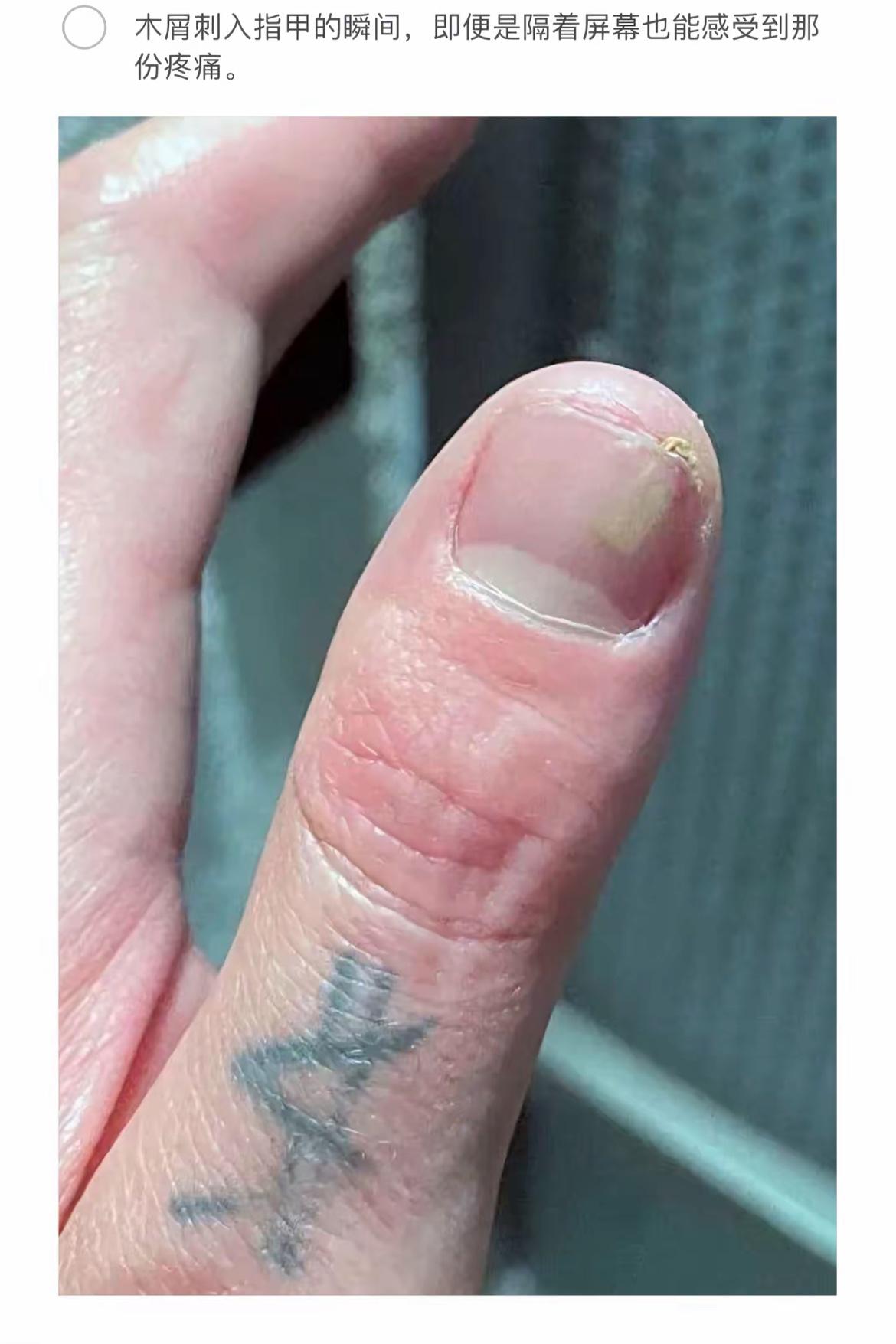 手指受伤瞬间，隔着屏幕都能感受到的疼痛！💔👉