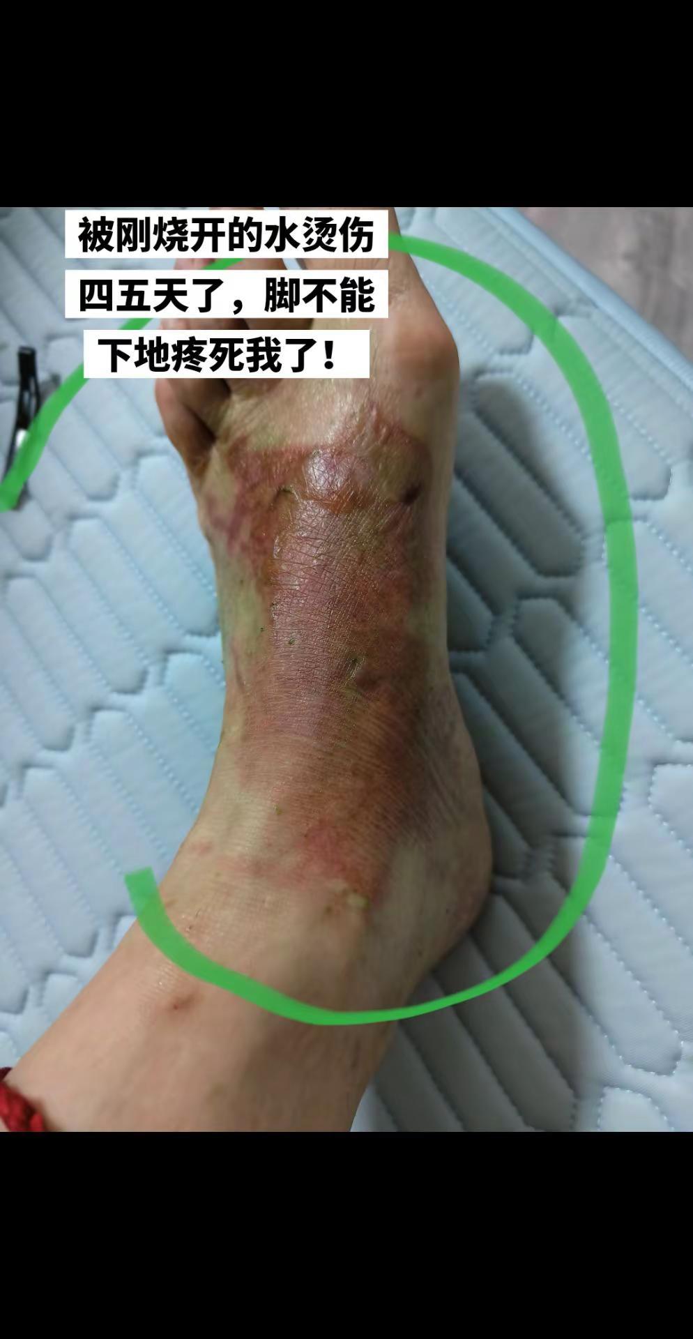被刚烧开的水烫伤四五天了，脚不能下地疼死。最近灾气太重了，胆结石折腾的住院，因牵