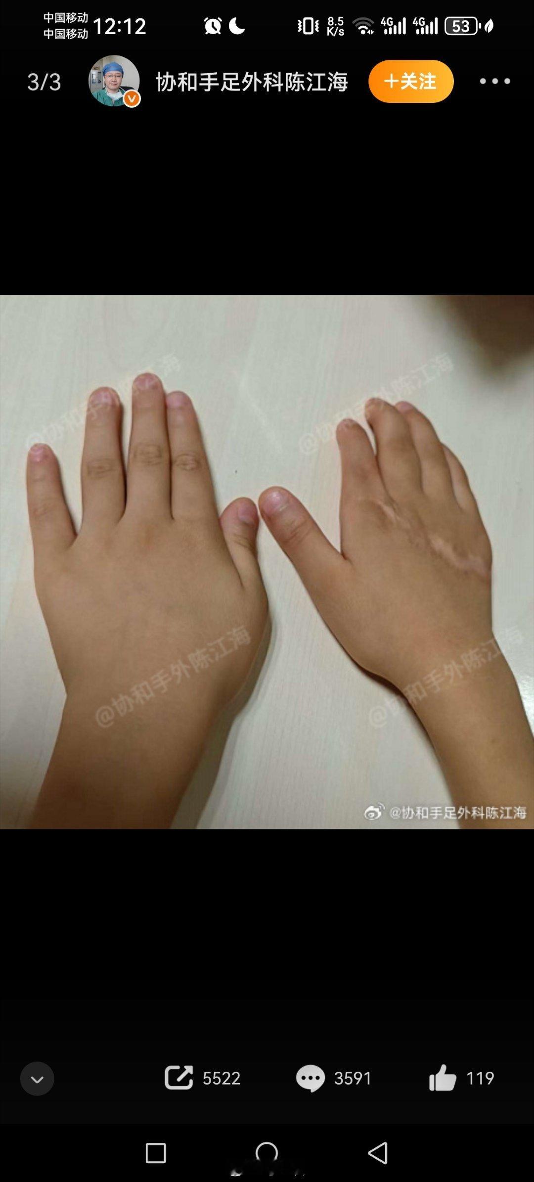男童被绞断4根手指已恢复如初 学医的意义！[good][good][good] 