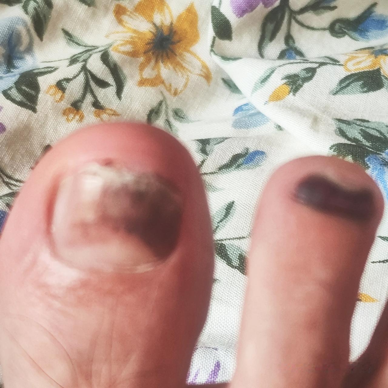 参加马拉松比赛以来同一个位置，第二次黑脚指甲。不痛不痒但必须吸取教训。
第一次黑