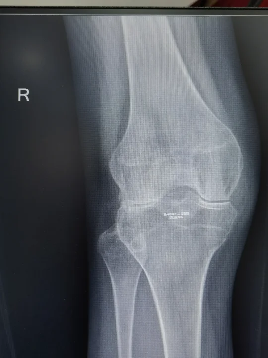 年纪轻轻膝关节破坏，如何是好？