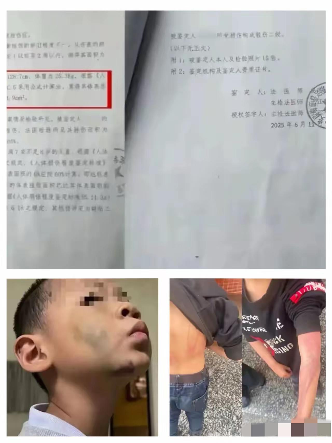 湖南武冈这事儿真是震碎三观，

​那个后妈居然还是烧伤科的护士！
​
偏偏用专业