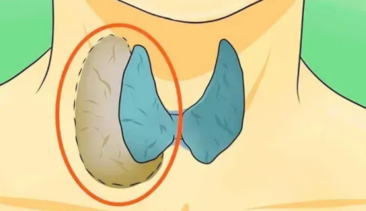 硬核研究所 【良性甲状腺结节基本不会转恶】甲状腺癌是否需要切除 发表在《柳叶刀·