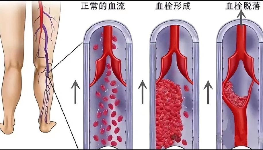 当下的牛马们，切忌久坐!
血栓并不遥远。