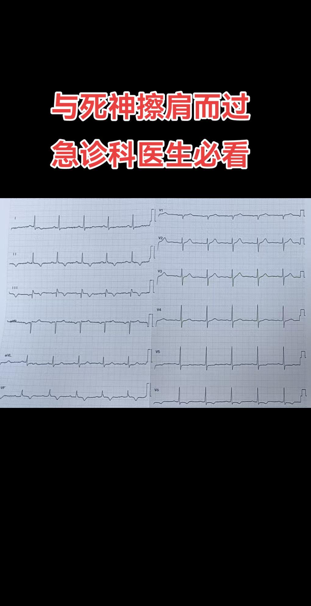 高危心电图。患者有胸痛表现，心电图如上，千万别轻轻一瞥，患者心电图表现...