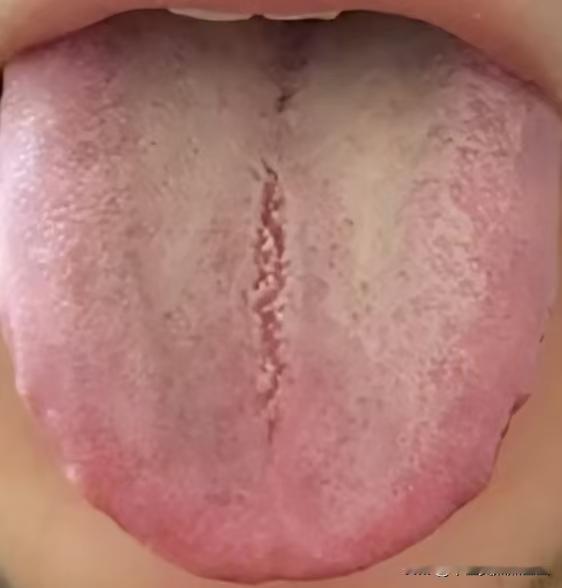 舌中有裂纹，舌苔厚腻，碰见这种舌头，病根可不在脾胃!

患者主诉：轻微早泄，总是