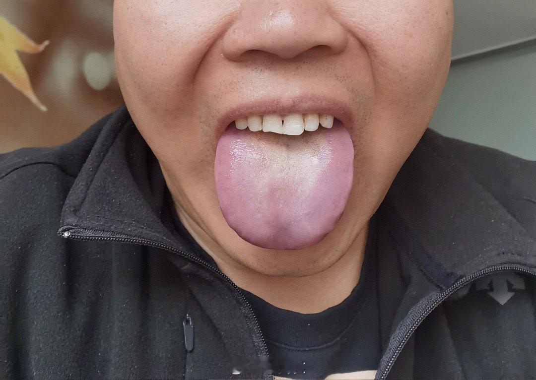 新冠别乱吃药昨日搬家忙乱之中，老友来电，在京出差，发热三天，肌肉针注射，连花清瘟