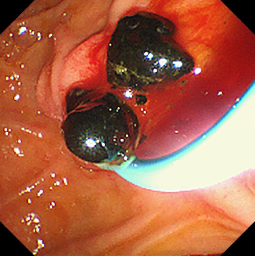 周日急诊为患者解决胆结石引起的胆绞痛！胆管结石嵌顿的疼痛有多痛？！疼痛...