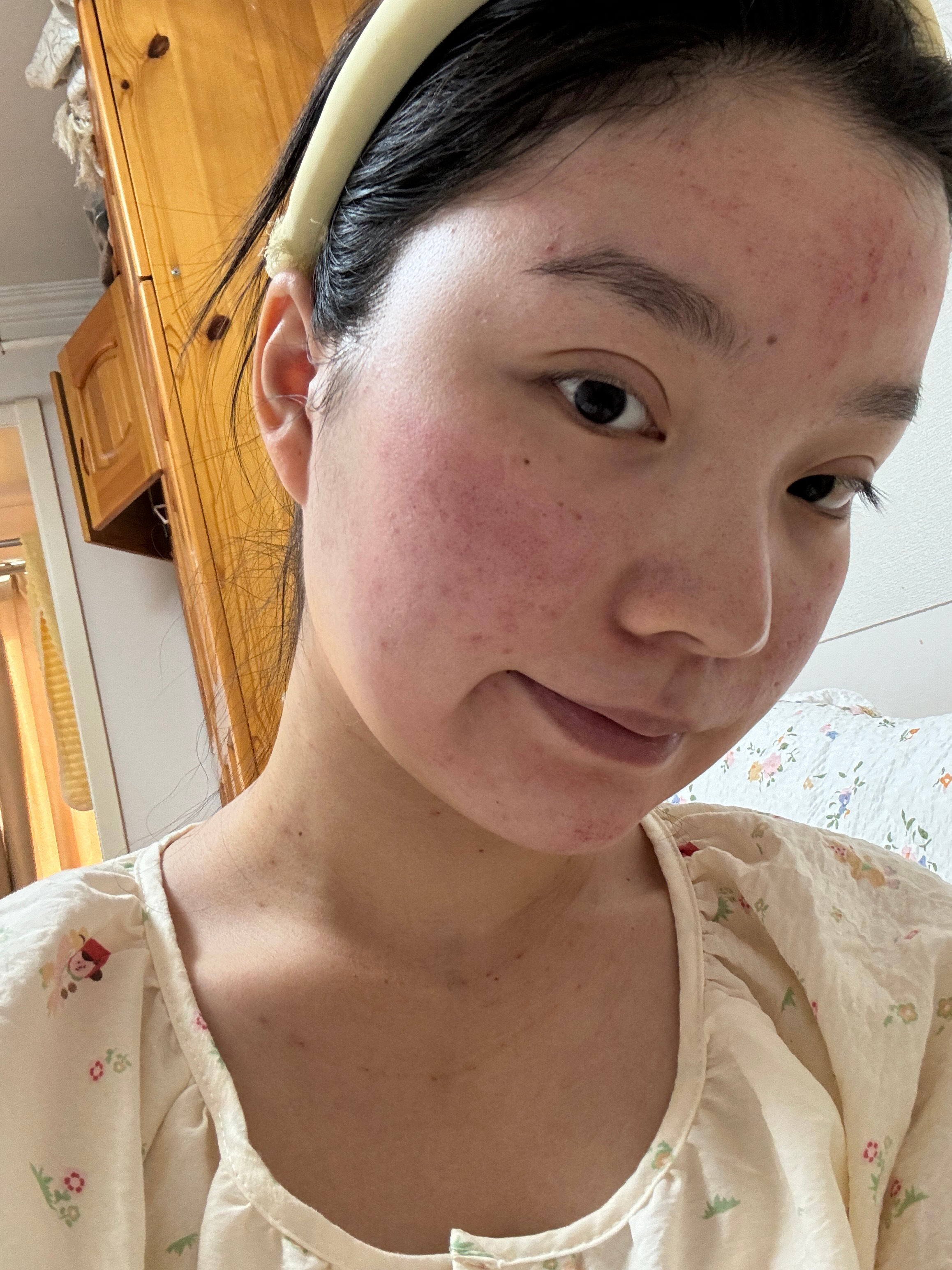 今天又去搞了一个微针  伊肤泉的祛痘套组 现在脸巨红 希望有效果 ​​​