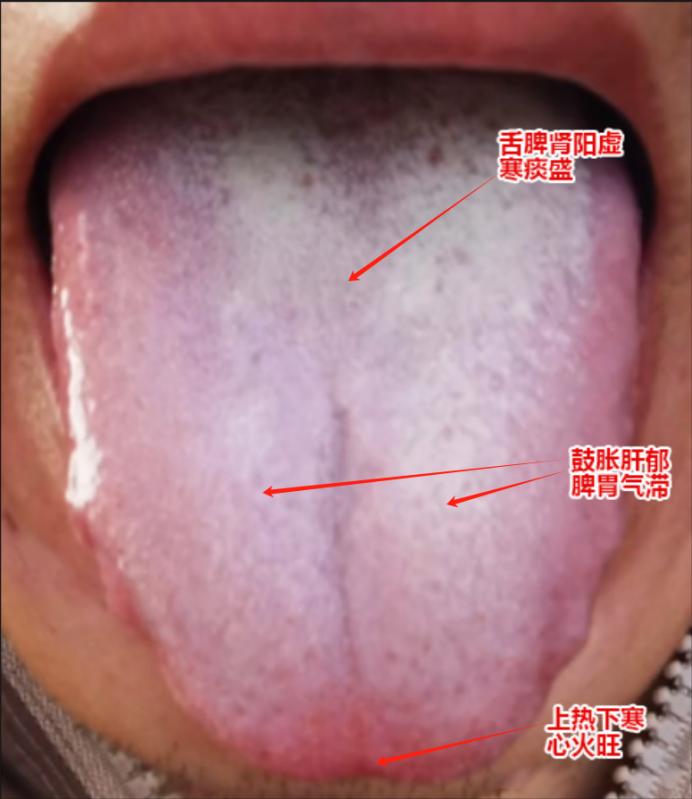 明明是脾肾阳虚，体内湿邪过重，可为什么吃了燥湿散寒的“附子理中丸”却没有用呢？甚
