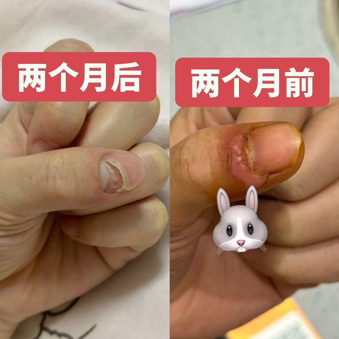 #女子拔倒刺指甲开裂险截肢#【女子拔倒刺后，指甲开裂险截肢 医生：一年接诊十多名